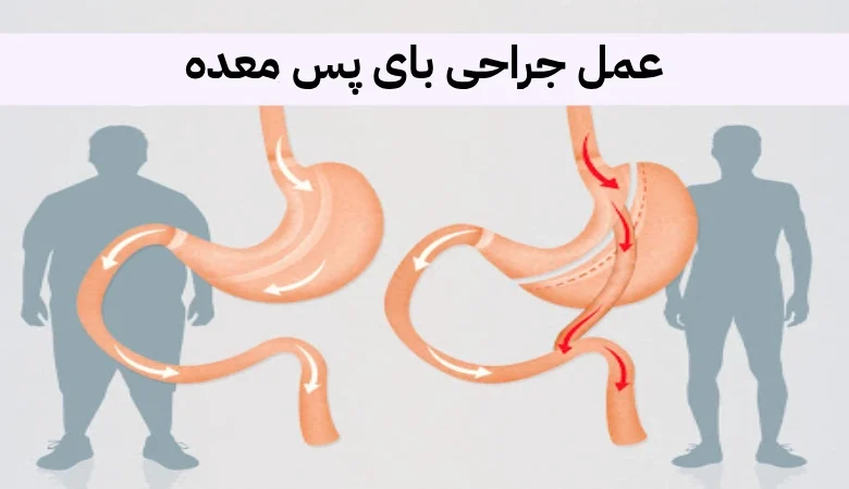 بارداری بعد از عمل بای پس معده؛ همه آنچه باید بدانید